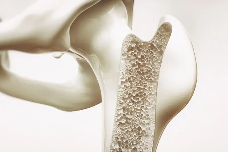 osteoporosis